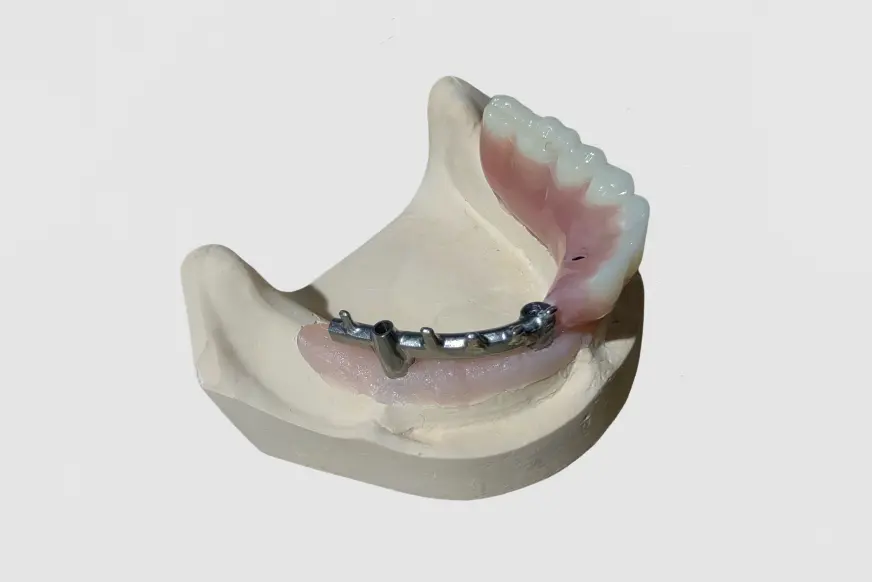 Bar-Cage Implant-Covered Denture (5)
