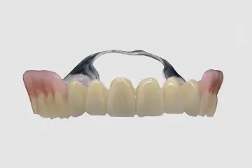 Telescopic Crown - Dual-Crown Implant Dentures