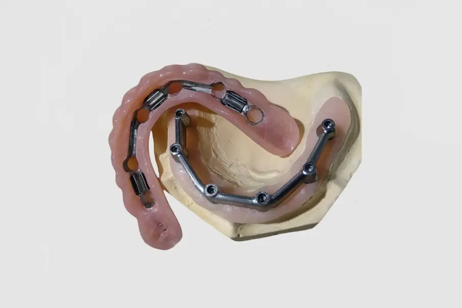 Bar-Cage Implant-Covered Denture (4)