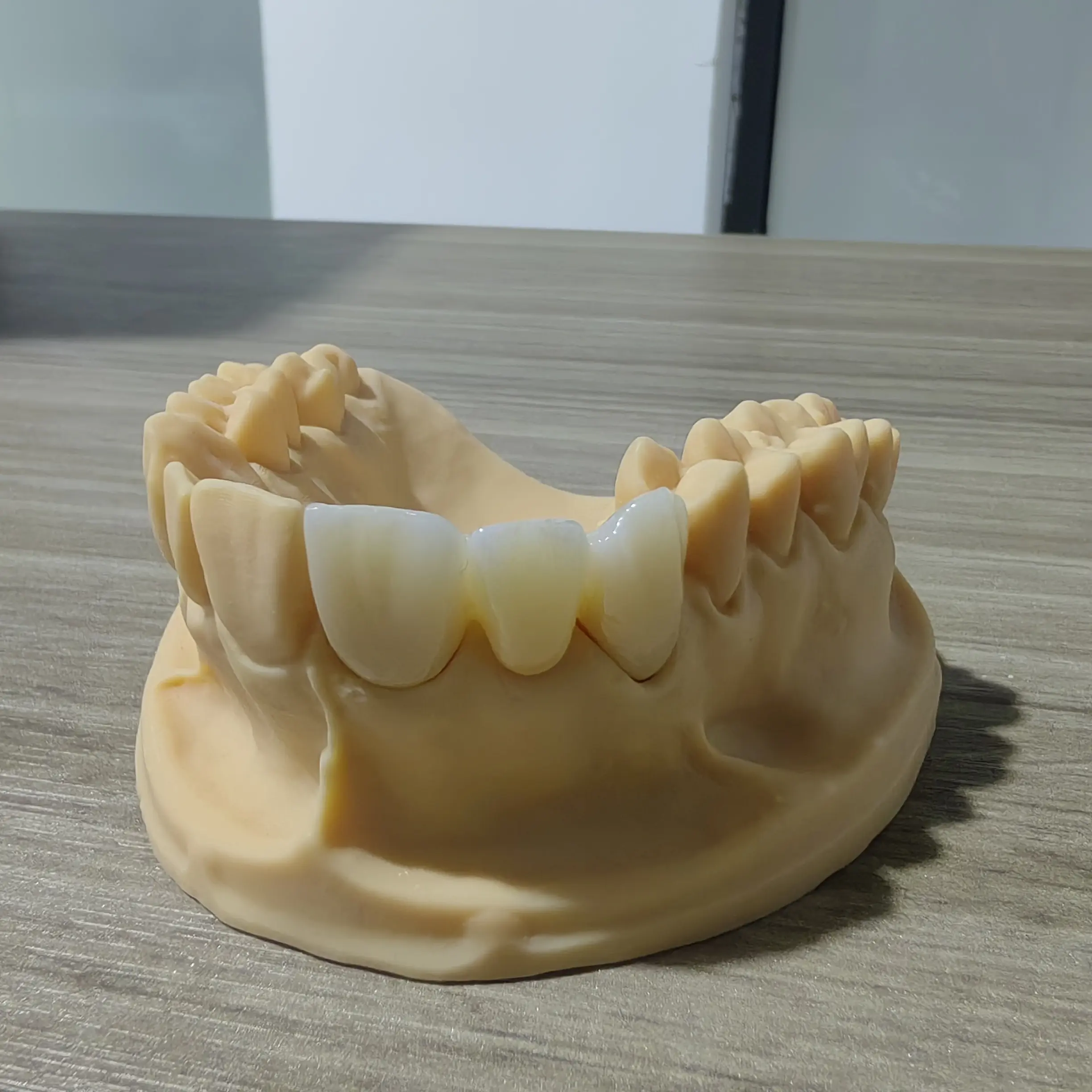 3 Full-Arch Zirconia Bridge for an American Client