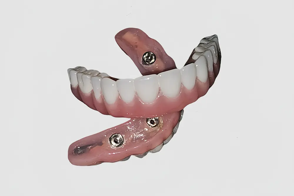 Screw-Retained Hybrid Denture (4).jpg