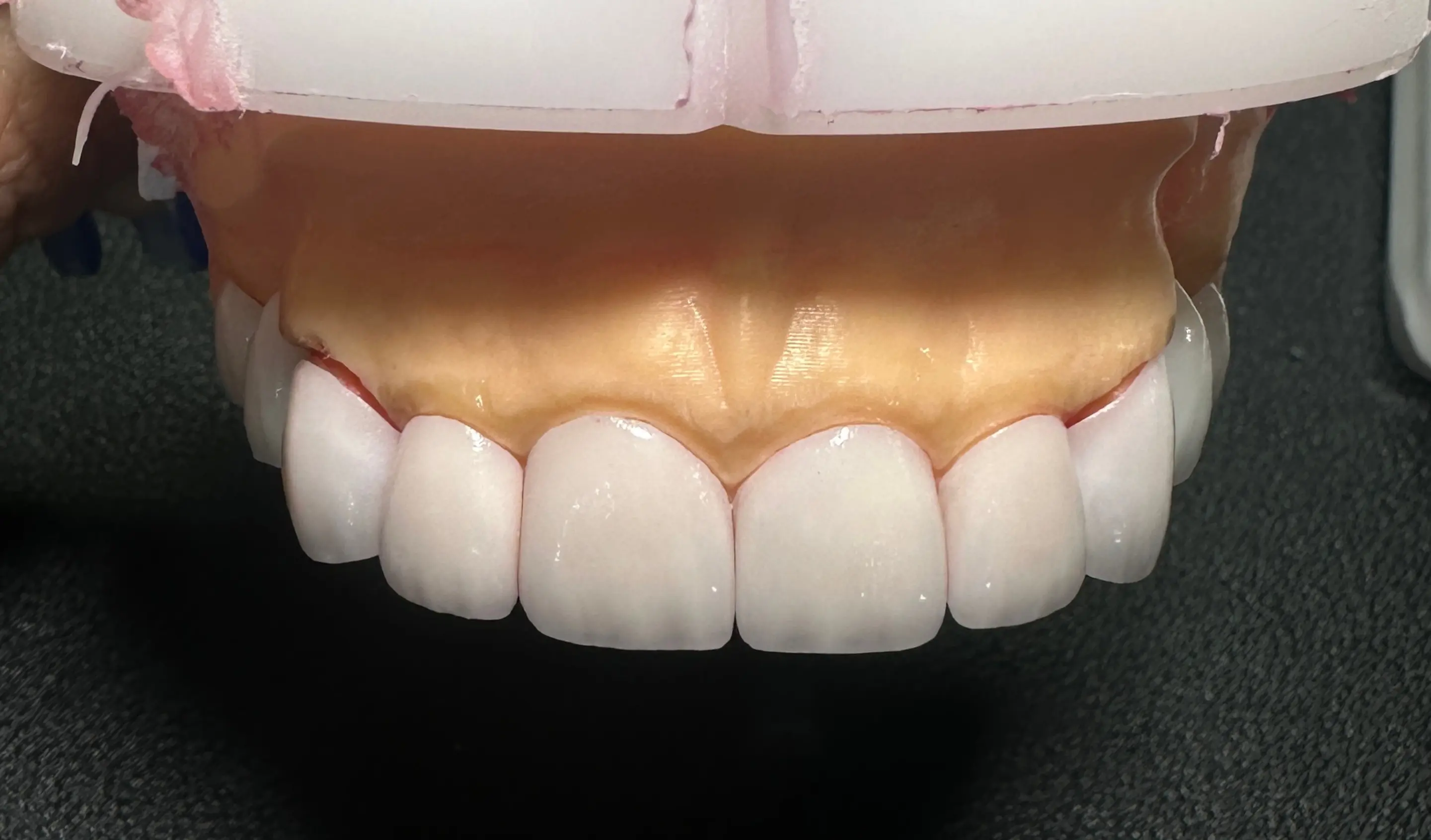 Digital Veneer Solutions from a Trusted Chinese Dental Lab