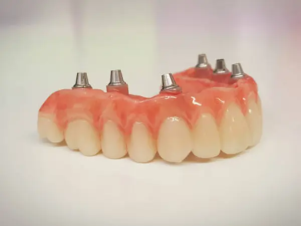 Implant Dentures