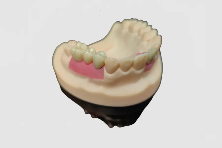 Implant Crown&Bridge (4)