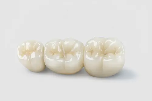 Porcelain-Fused-to-Metal (PFM) (4).jpg