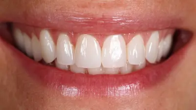 Ultimate Guide to Choosing the Right Cosmetic Dental Veneers for Your Perfect Smile