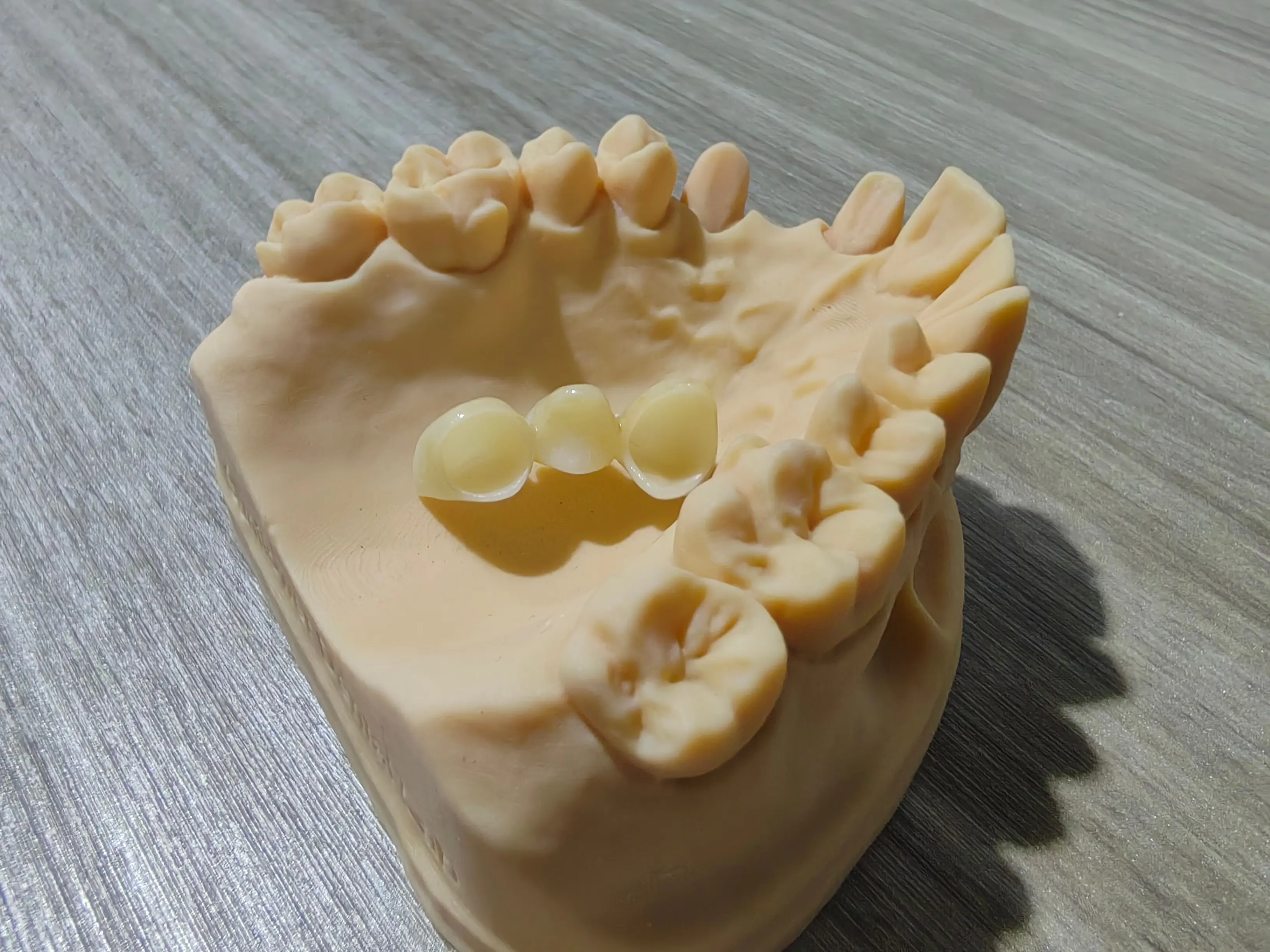 1 Full-Arch Zirconia Bridge for an American Client