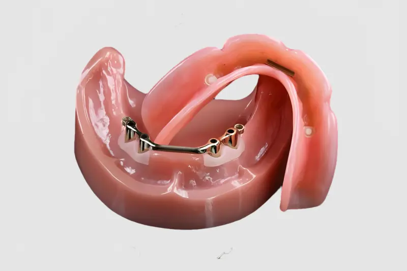 Bar-Cage Implant-Covered Denture (3).jpg
