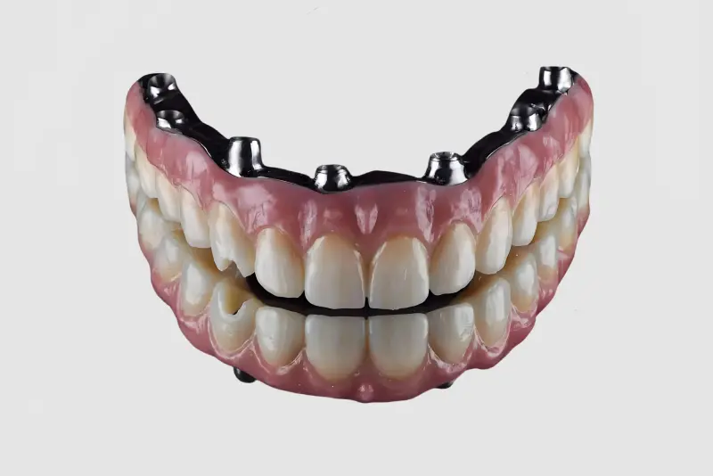 Screw-Retained Hybrid Denture (2)