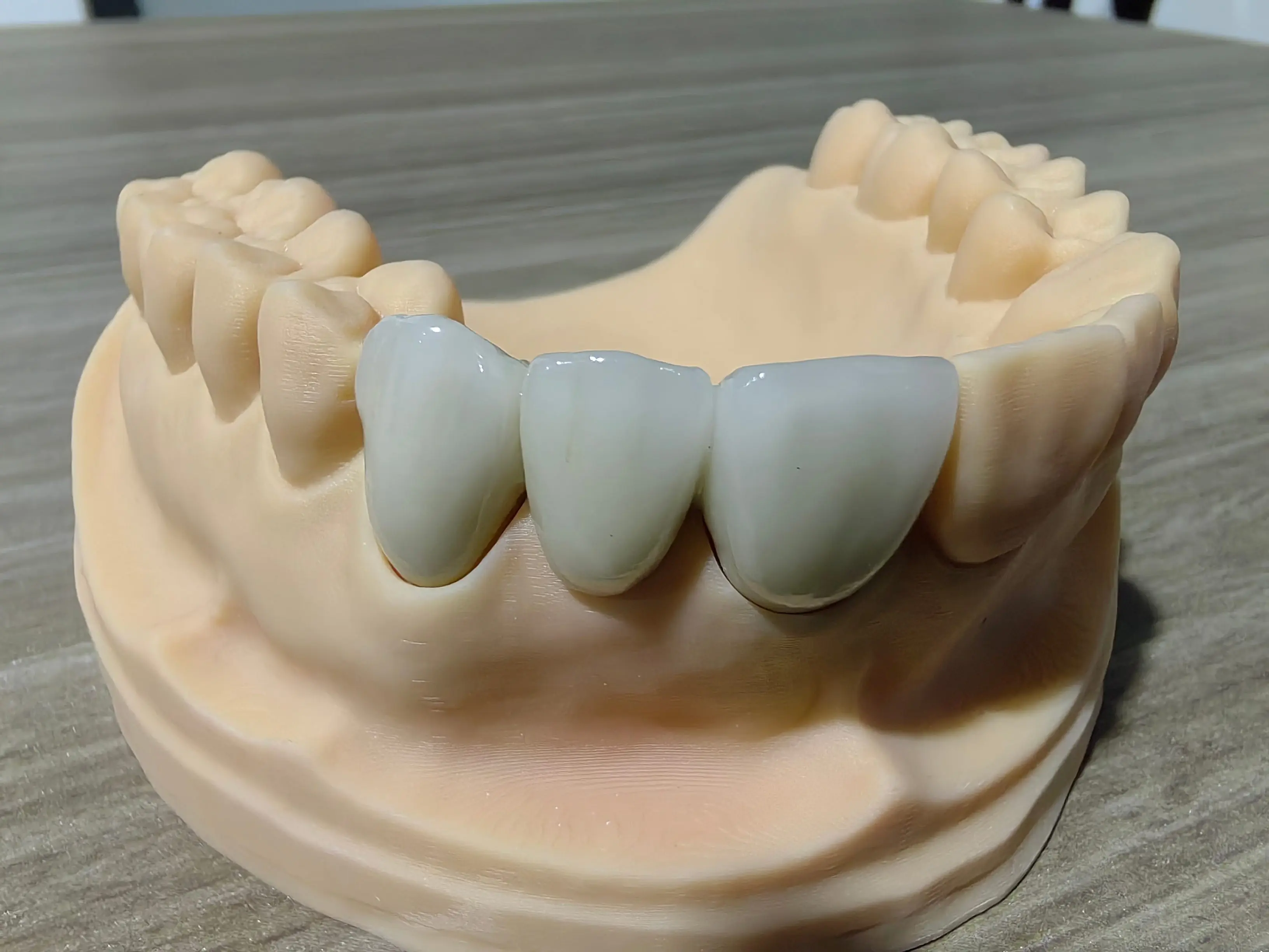 Case Study: Full-Arch Zirconia Bridge for an American Client