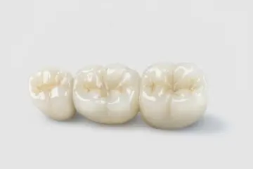 Porcelain-Fused-to-Metal (PFM)