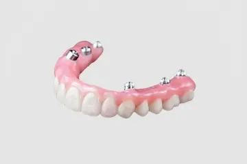 Screw-Retained Hybrid Denture