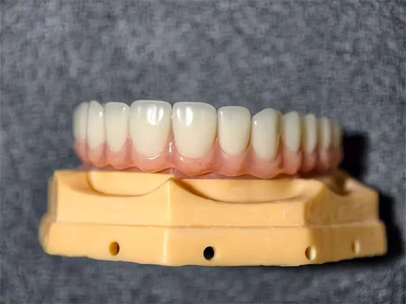 Why Choose Digital Dental Implants
