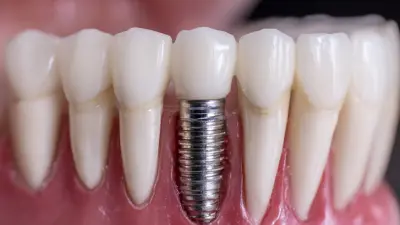 2025 Top 10 Digital Dental Implants: Best Innovations for Your Smile
