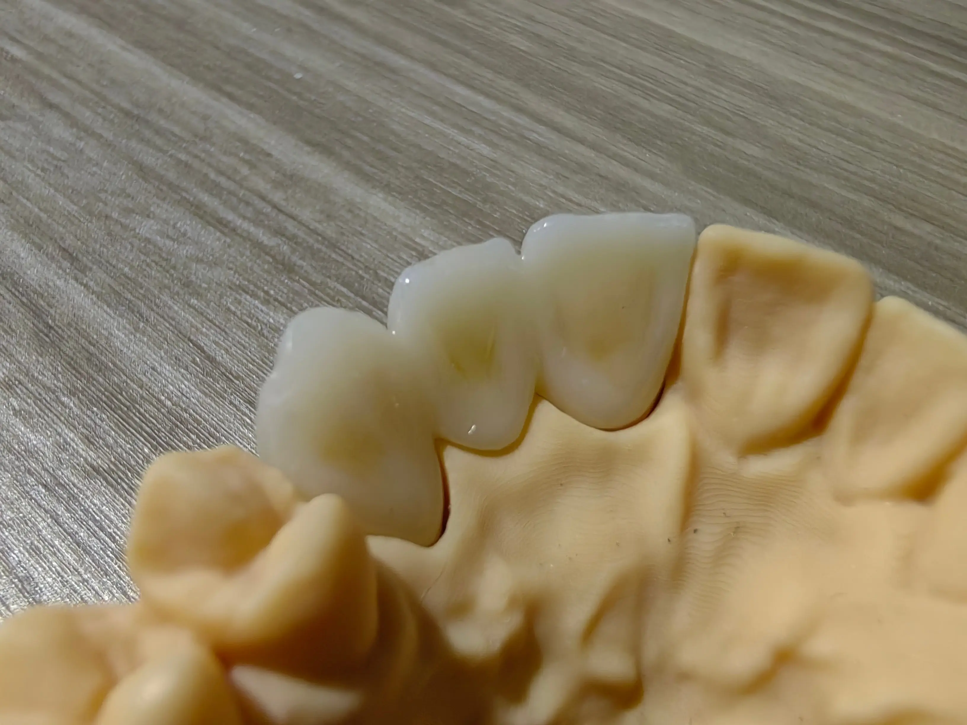 2 Full-Arch Zirconia Bridge for an American Client