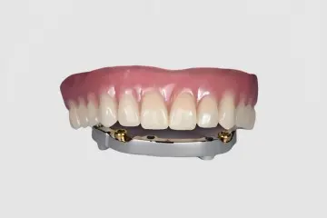 Bar-Cage Implant-Covered Denture